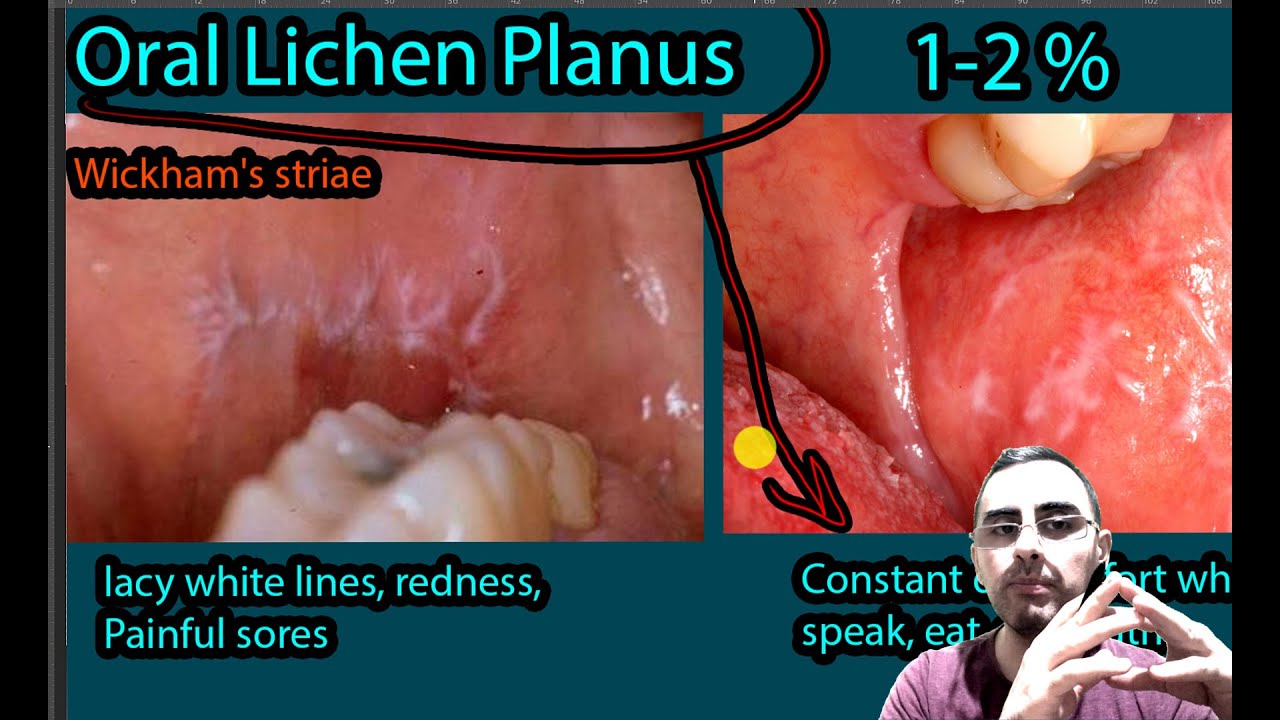 Oral Lichen Planus - Symptoms, Causes, Treatment. Wickham's striae - Lichen Planus In De Mond