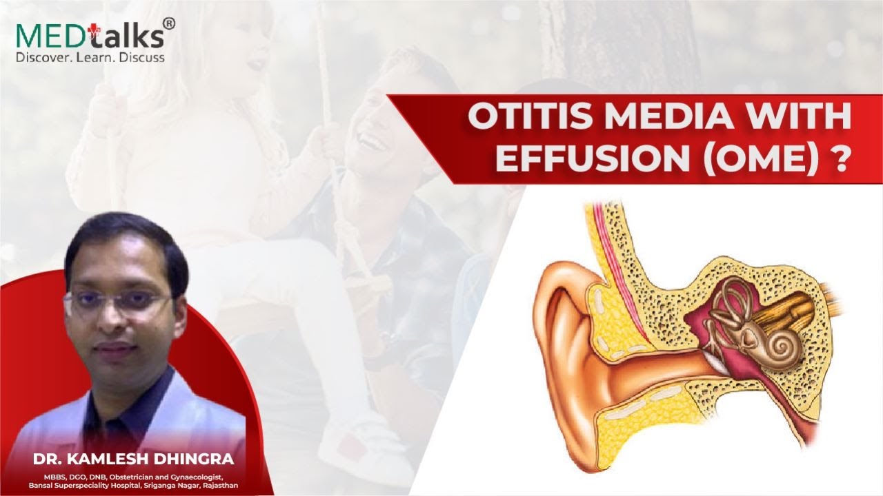 Otitis Media with Effusion (OME) ? - YouTube - Nhg Otitis Media Met Effusie