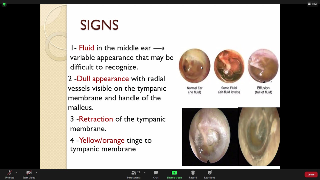 Otitis media with effusion - YouTube - Nhg Otitis Media Met Effusie