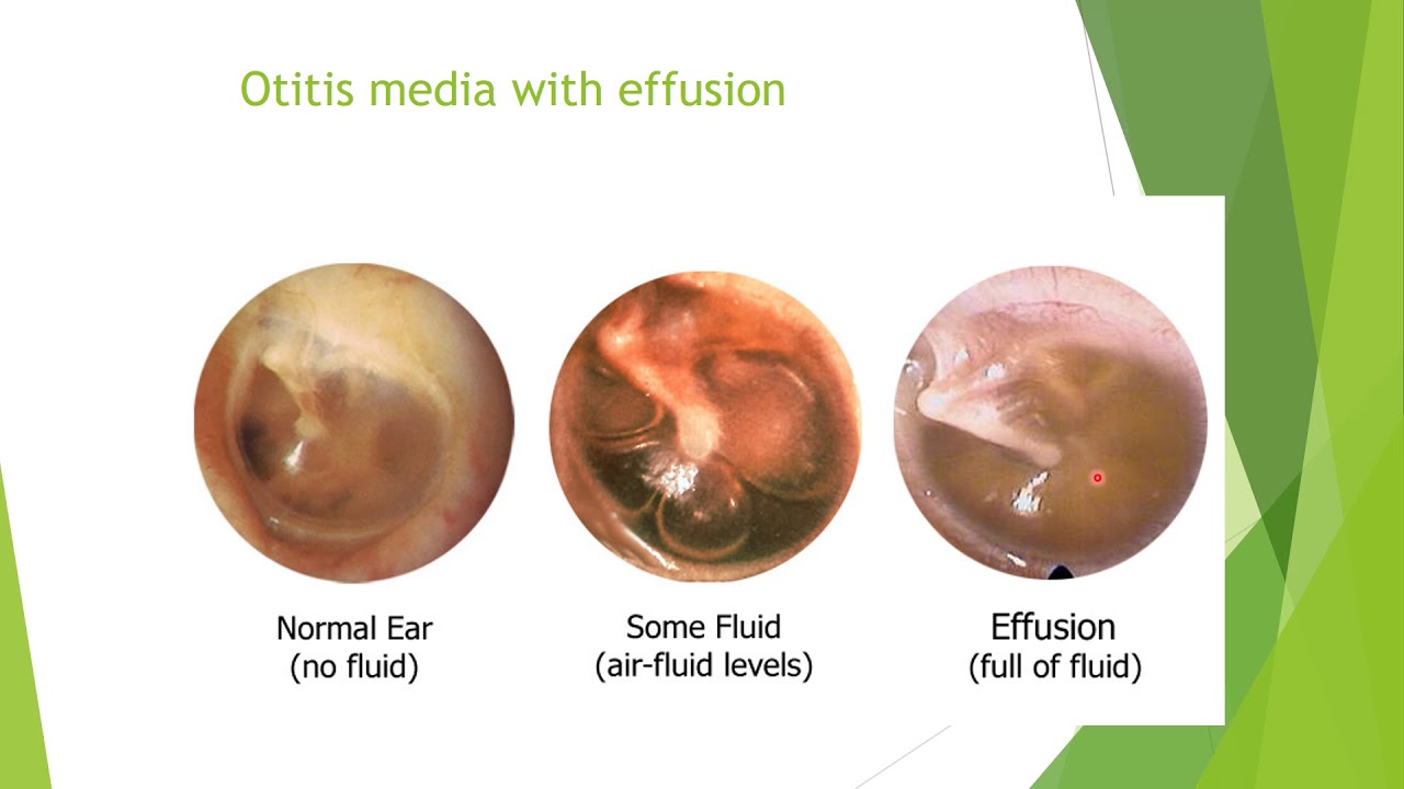 Otitis Media With Effusion - YouTube - Otitis Media Met Effusie Volwassenen