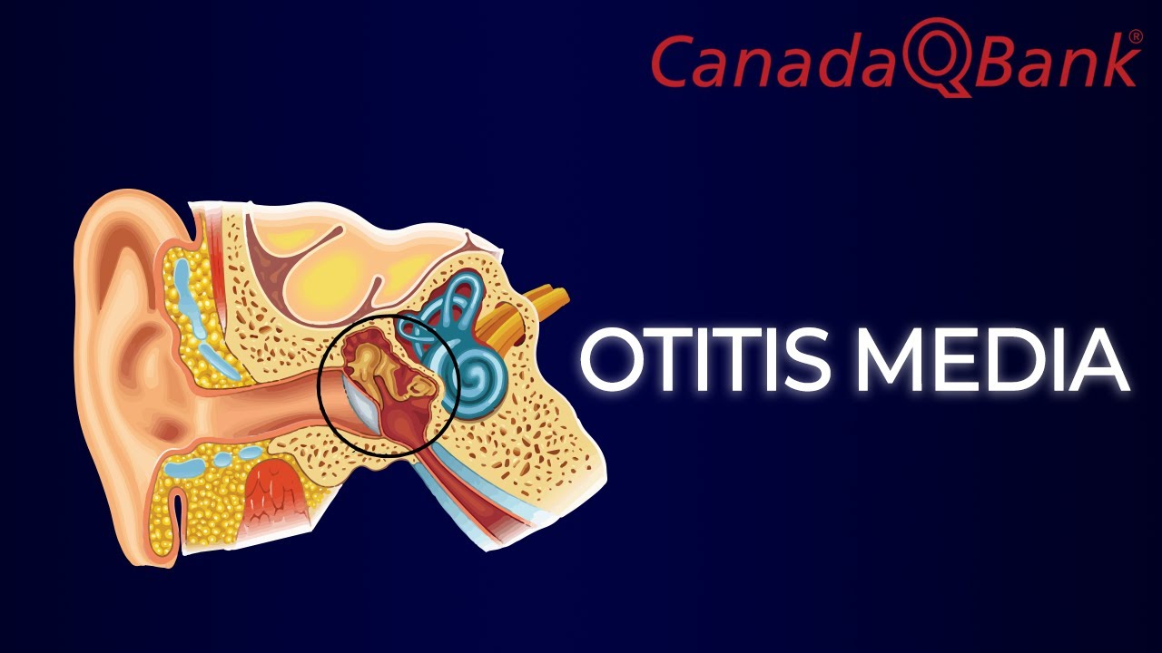 Otitis Media Met Effusie Volwassenen Nhg
