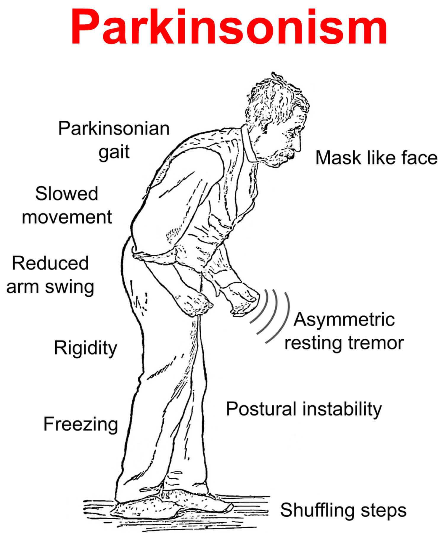 Parkinsonism Vs. Parkinson's Disease - Wat Is Het Verschil Tussen Parkinson En Parkinsonisme