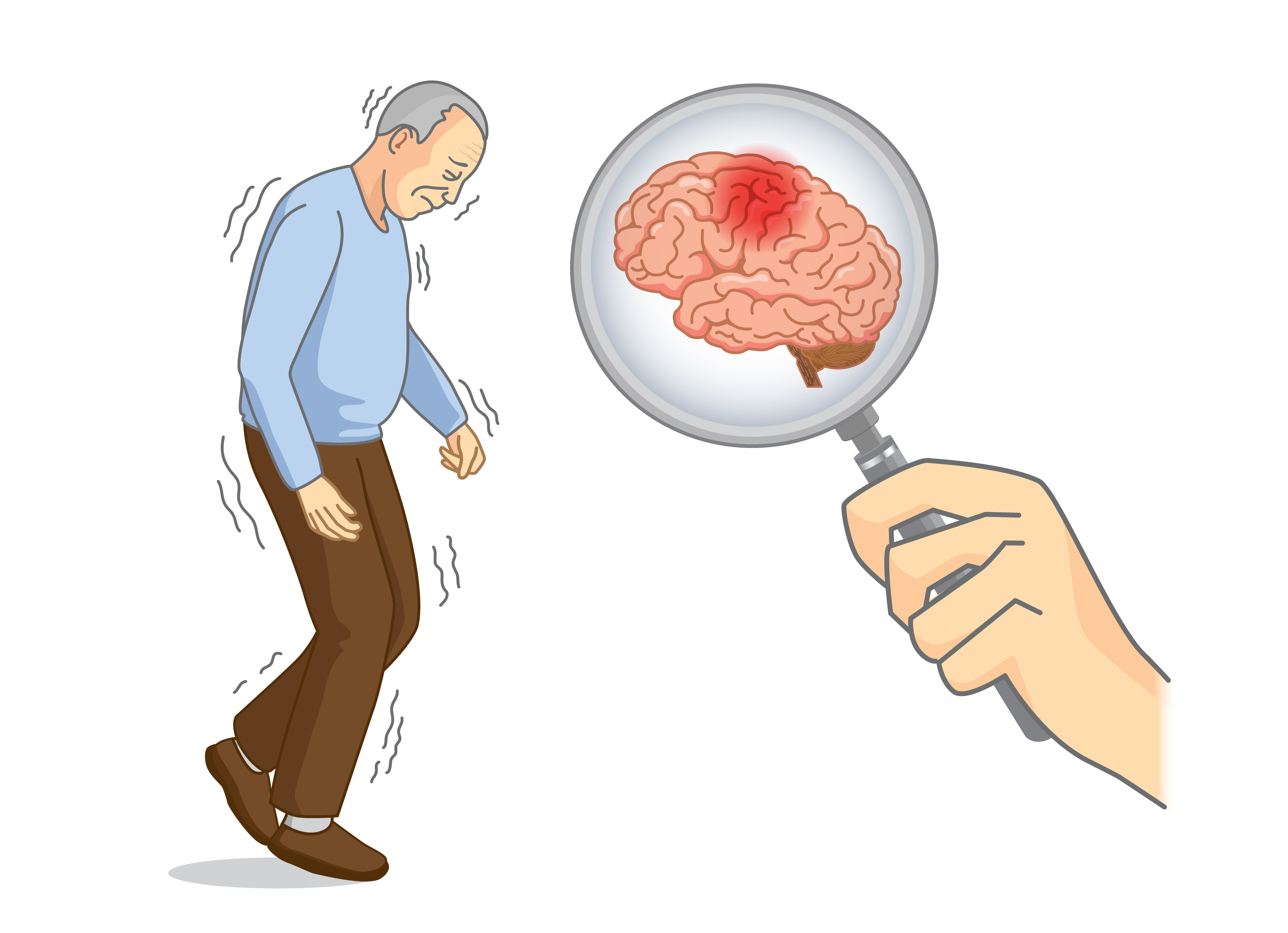 Parkinsons Disease - vrogue.co - In Welke Gebieden Komt Parkinson Voor