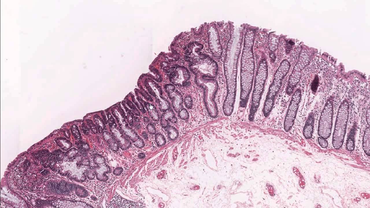 PathDoc15 Colon tubular adenoma demonstrating low grade dysplasia - Tubulair Adenoom Met Laaggradige Dysplasie Behandeling