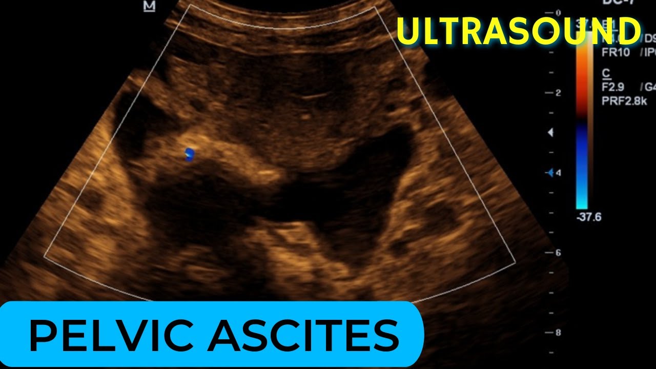 Pelvic ascites due to dilated cardiomyopathy on Ultrasound - YouTube - Cavum Douglasi Spoortje Vrij Vocht