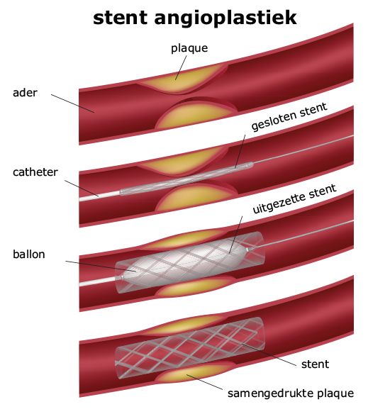 Perifeer Arterieel Vaatlijden (PAV) | Cursus | CME-Online - Verschil Perifeer En Arterieel Vaatlijden