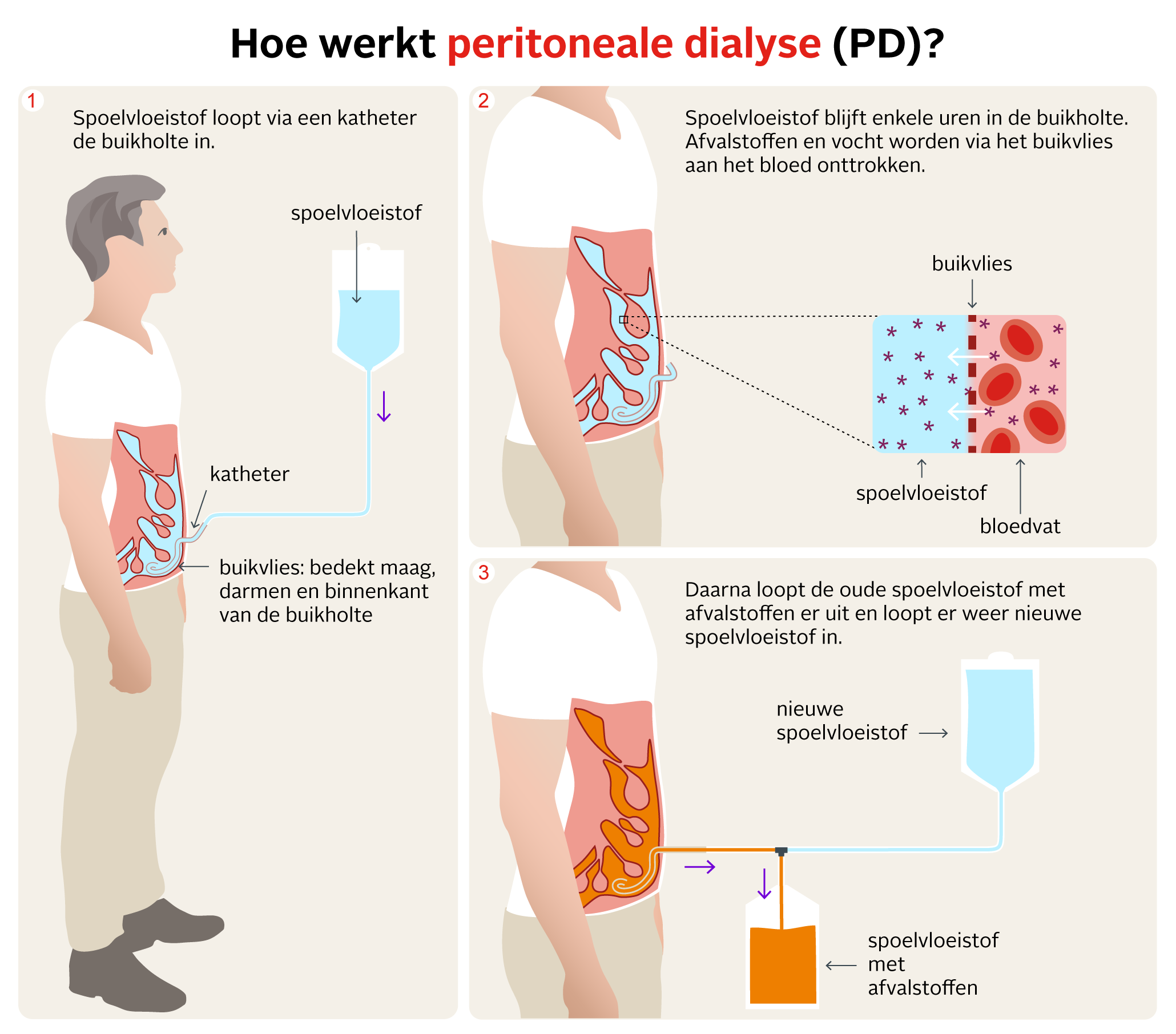 Peritoneaaldialyse (PD) doe je doorgaans thuis, vier of vijf keer per - Loratadine 2 Keer Per Dag