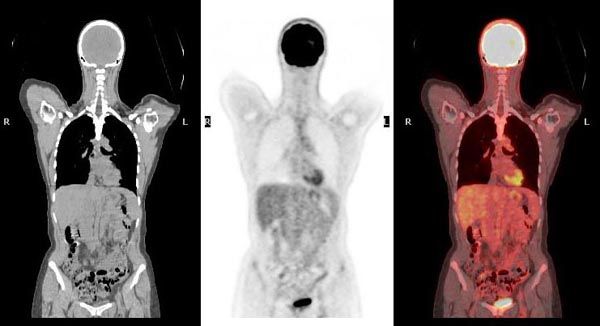 Verschil Ct Scan En Pet Scan