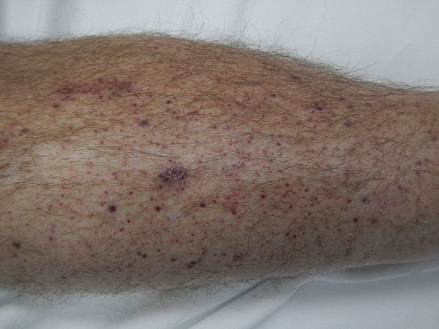 Petechiae | Characteristics, Causes, Symptoms, Diagnosis & Treatments - Puntbloedinkjes Rode Puntjes Op Huid