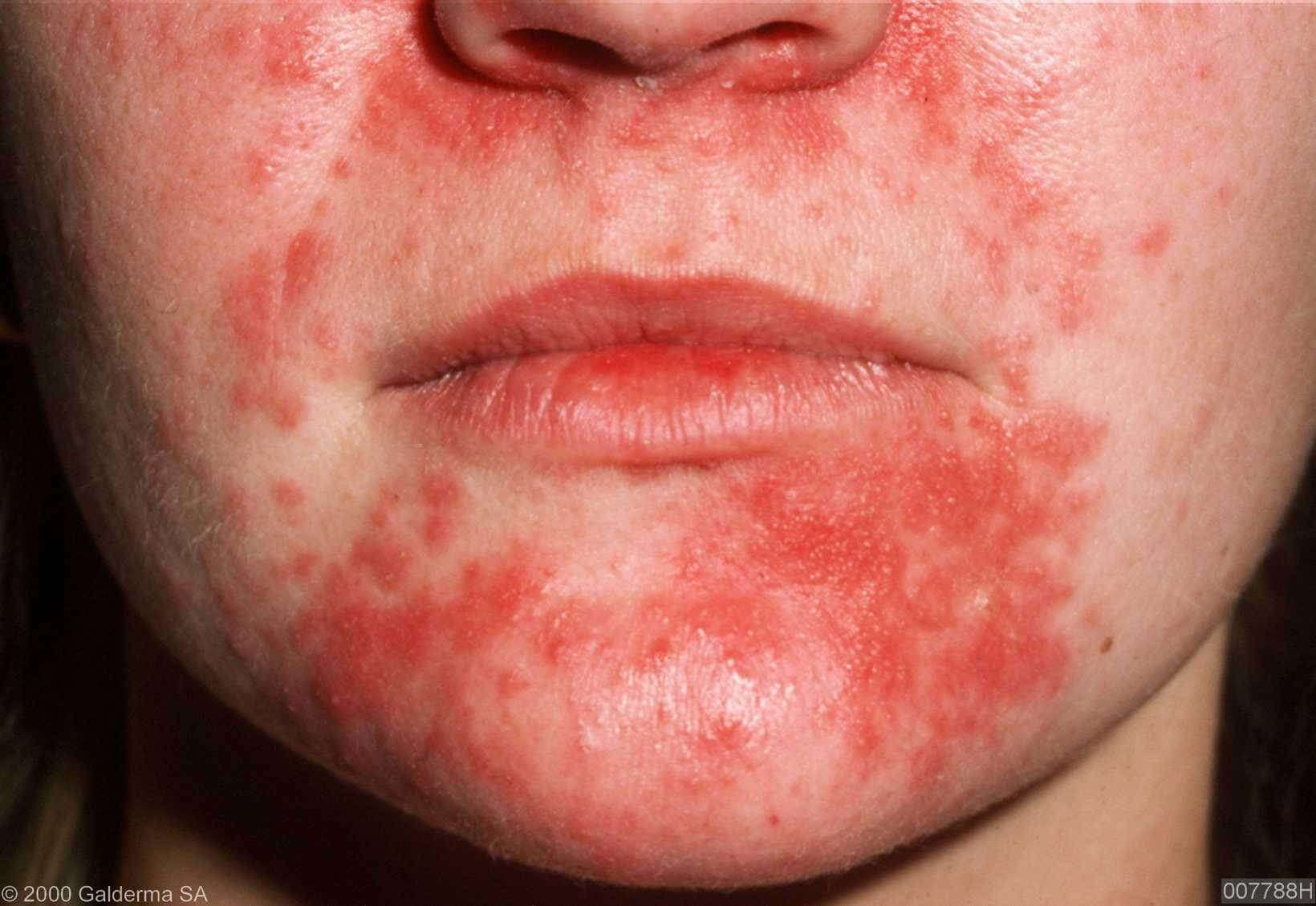 Bruine Vlekken Op Huid Schimmel