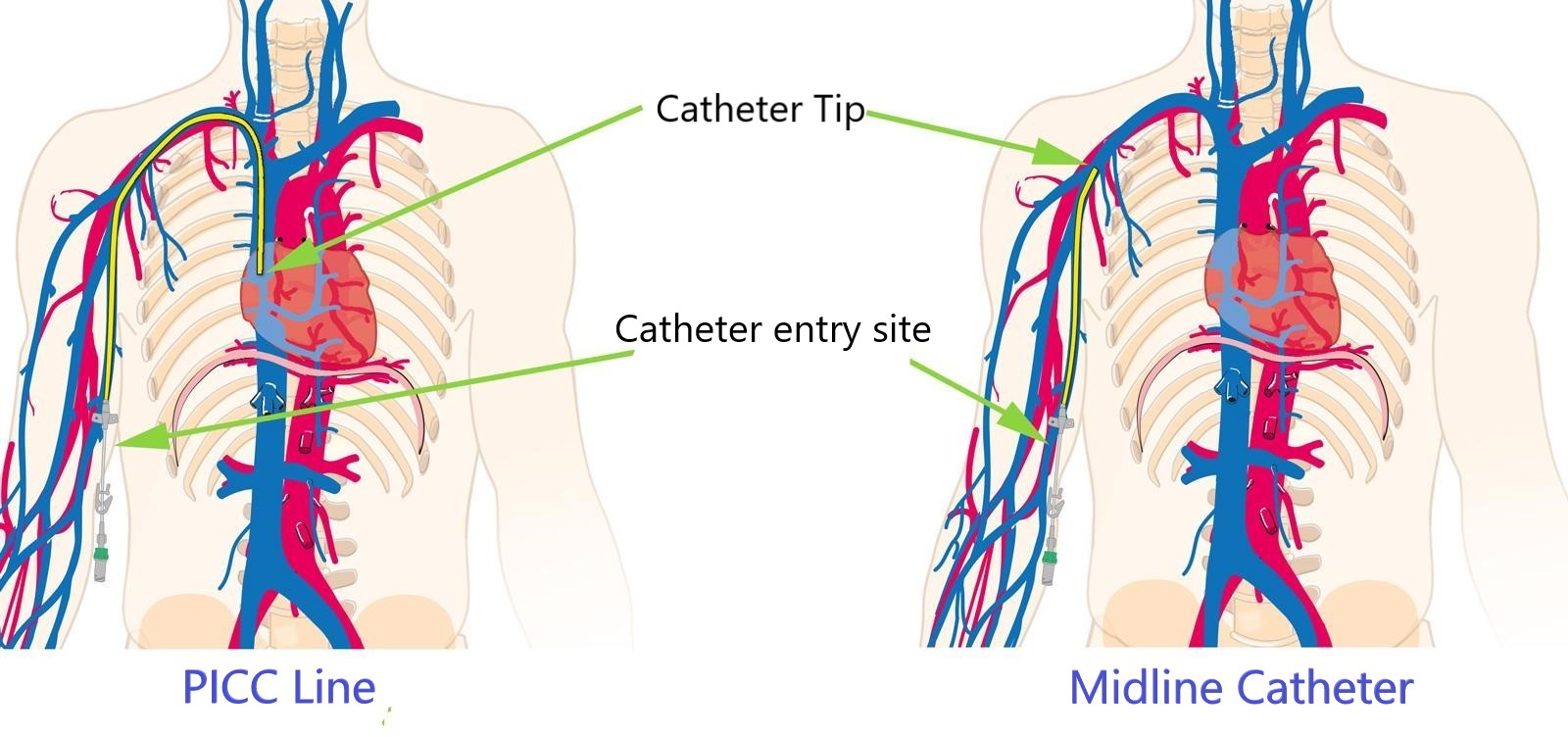 Picc Catheter - Verschil Picc Lijn En Centraal Veneuze Katheter