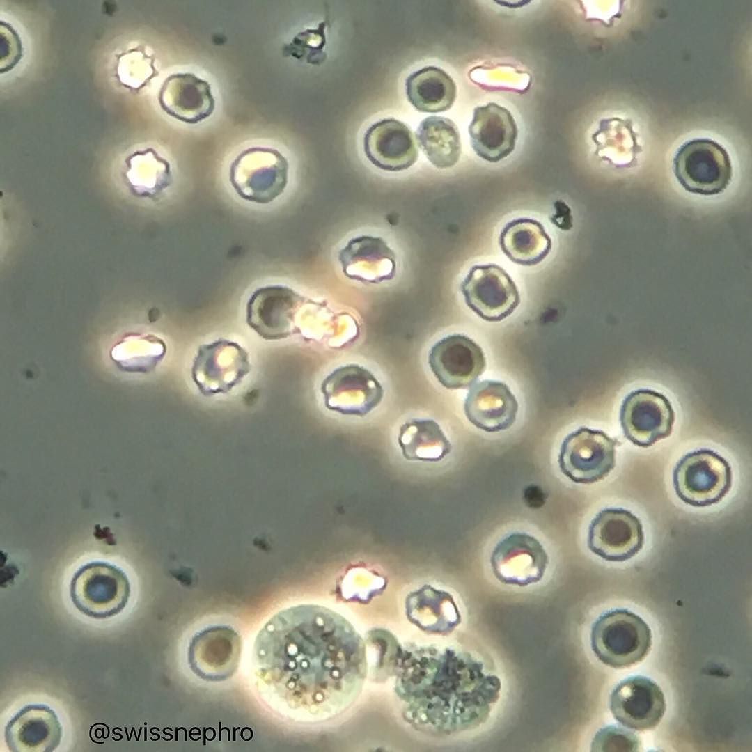 Erytrocyten In Urine Waarde 1