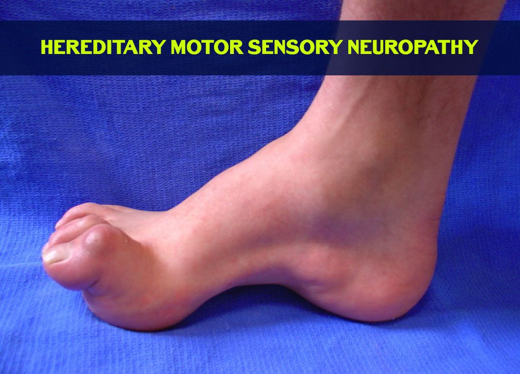 Hereditaire Motorische En Sensorische Neuropathie