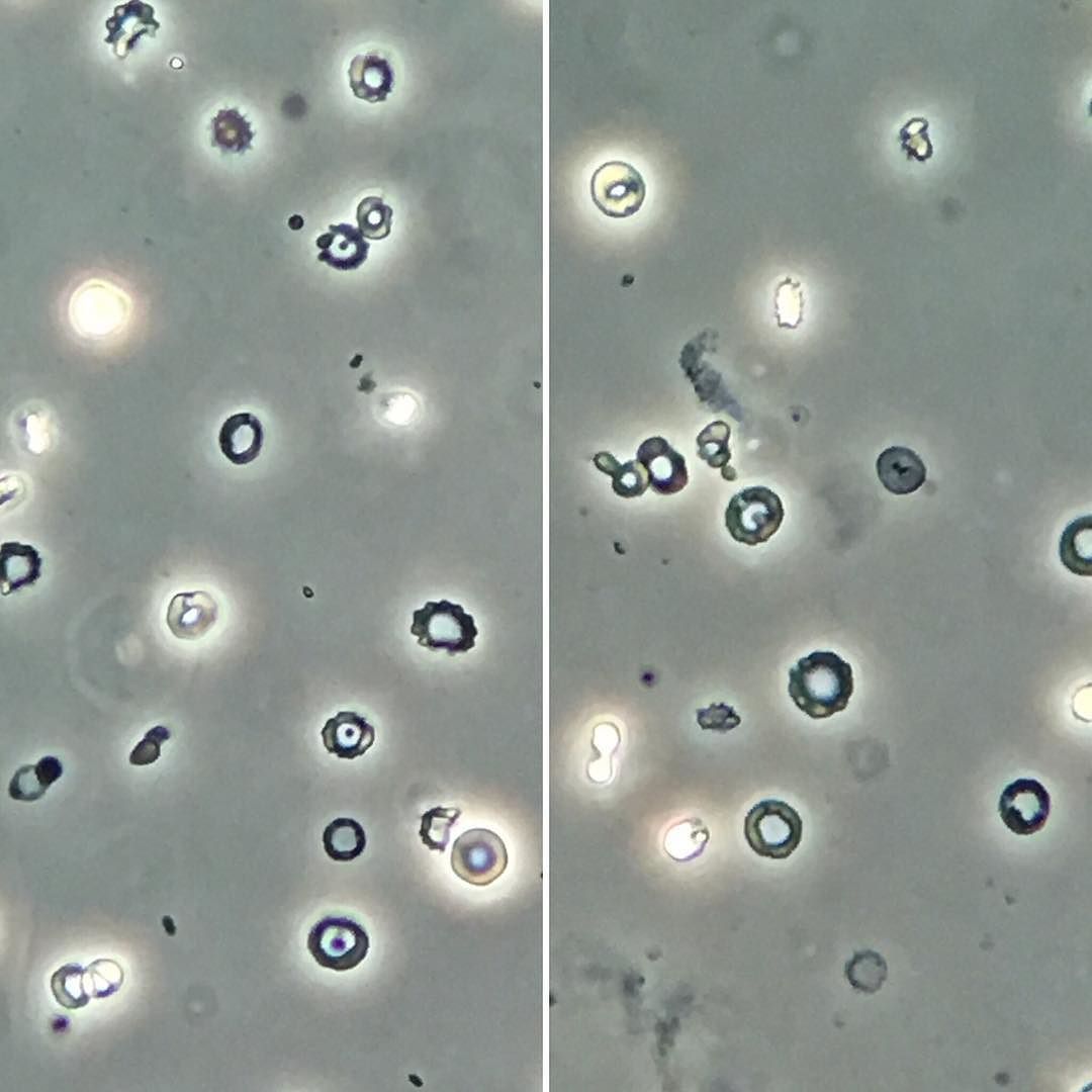 Pin on Cristaux urinaires - Erytrocyten In Urine Waarde 1