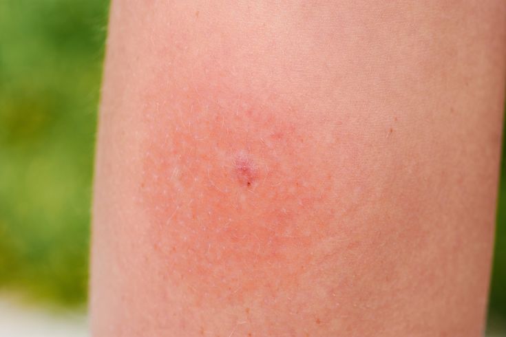 Pin on gezondheid - Gestoken Door Insect Rode Vlek