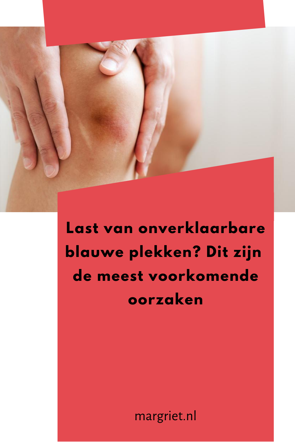 Blauwe Plekken Op Je Lichaam