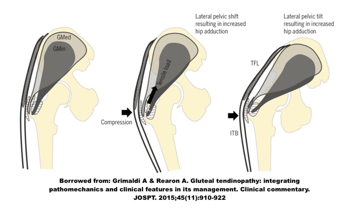 Greater Trochanteric Pain Syndrome Nederlands
