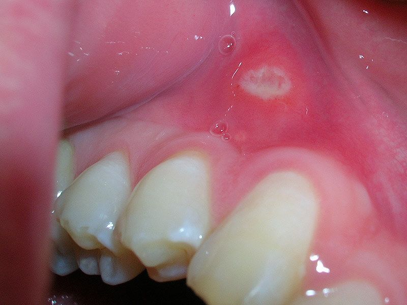 Pin on healthy - Wondjes In Mond Sneller Genezen