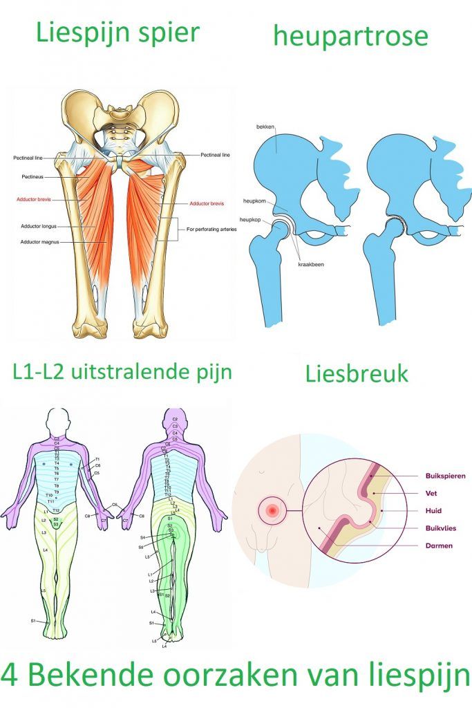 Pijn Rechter Bovenbuik Uitstralend Naar Rug