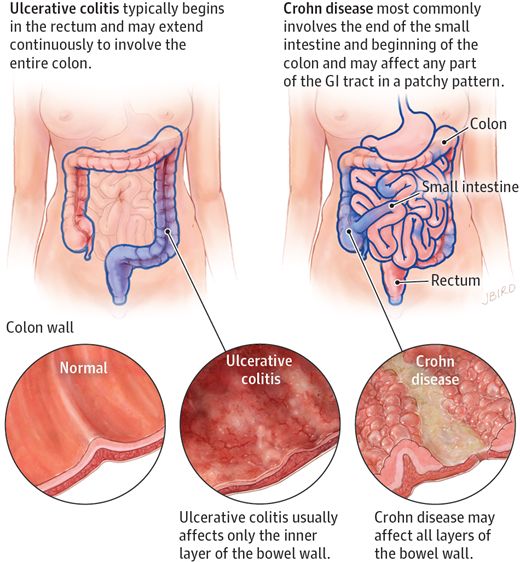 Pin on Ilze's favourites - Verschil Ziekte Van Crohn En Colitis Ulcerosa