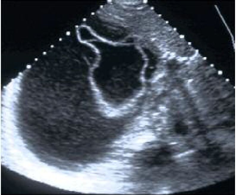 Verschil Cyste En Tumor Op Echo