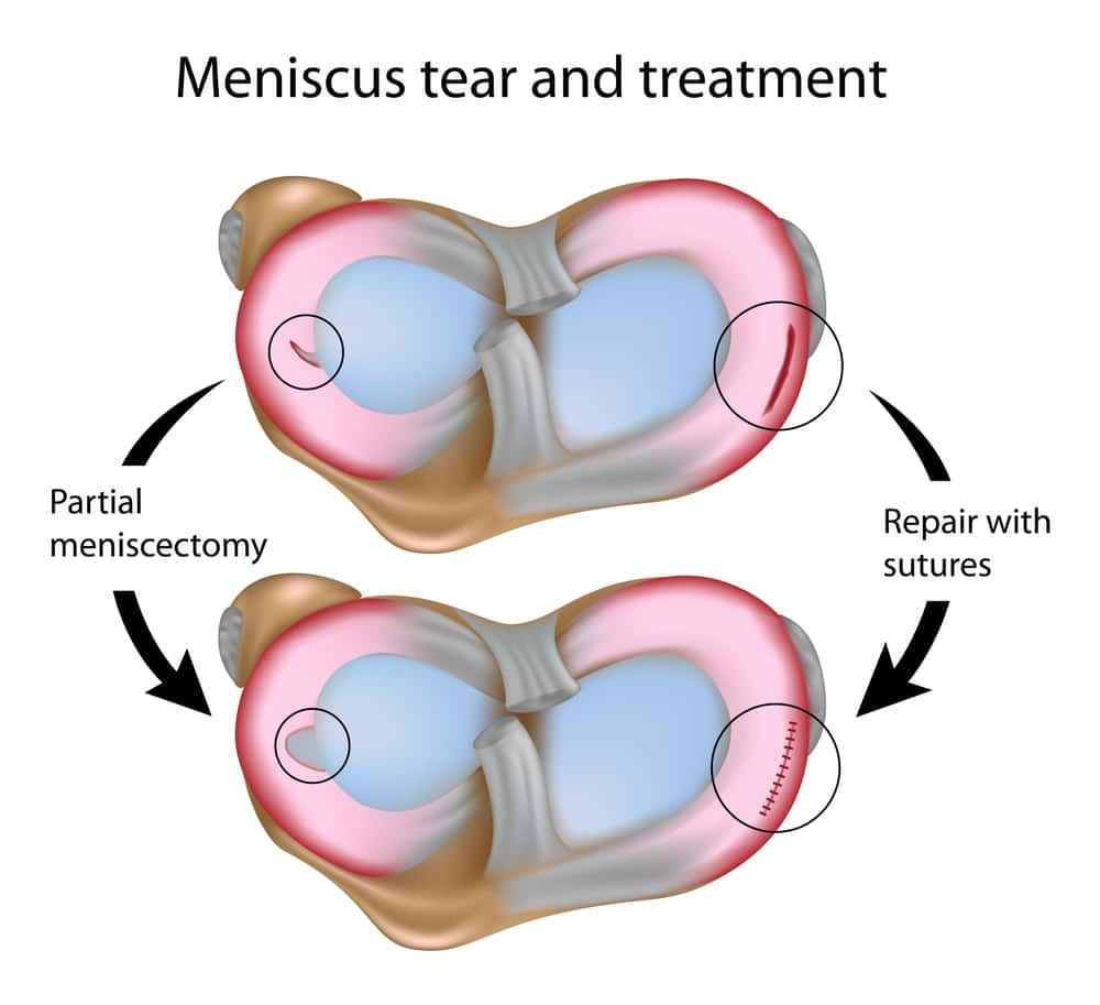 Pin on Nutrition, Health & Fitness - Complexe Scheur Achterhoorn Mediale Meniscus