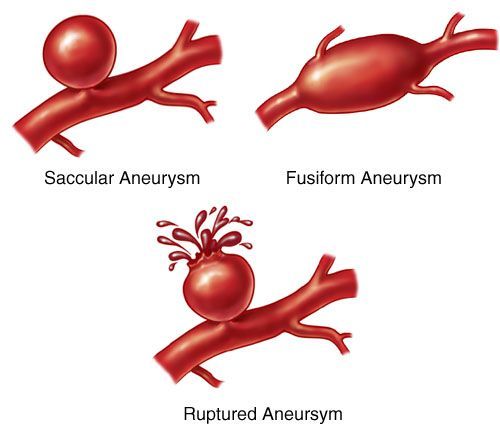 Aneurysma In Het Hoofd Symptomen