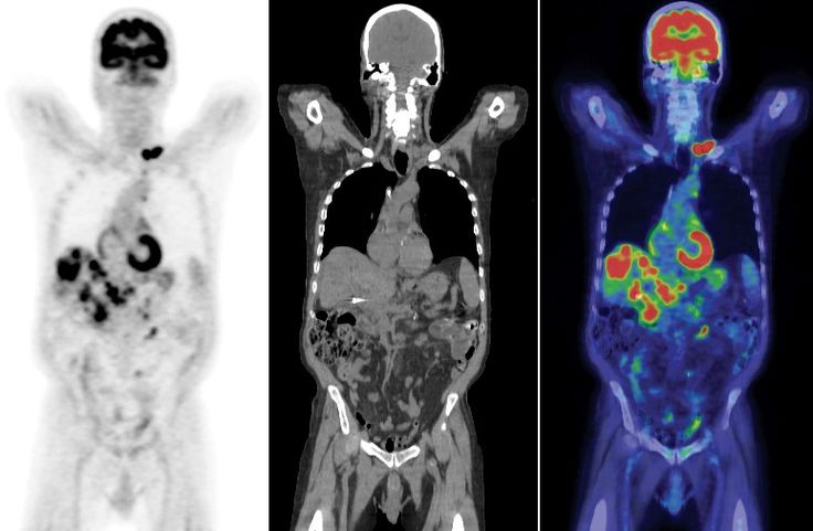 Verschil Mri En Pet Scan