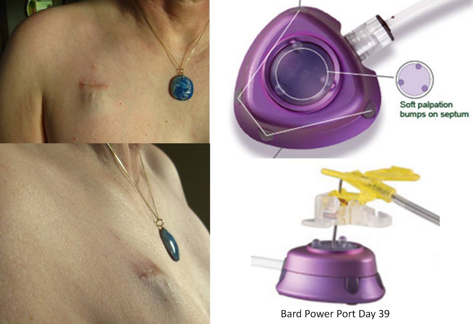 Pin on Vascular Access - Wat Is Een Port A Cath