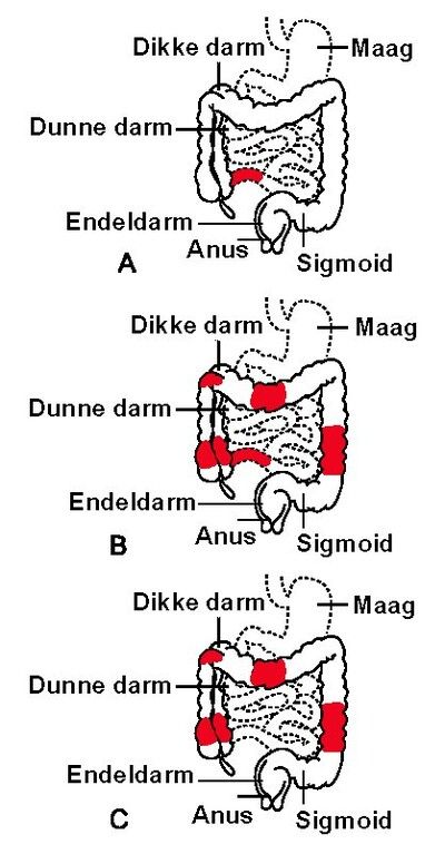 Ontsteking Van De Dikke Darm
