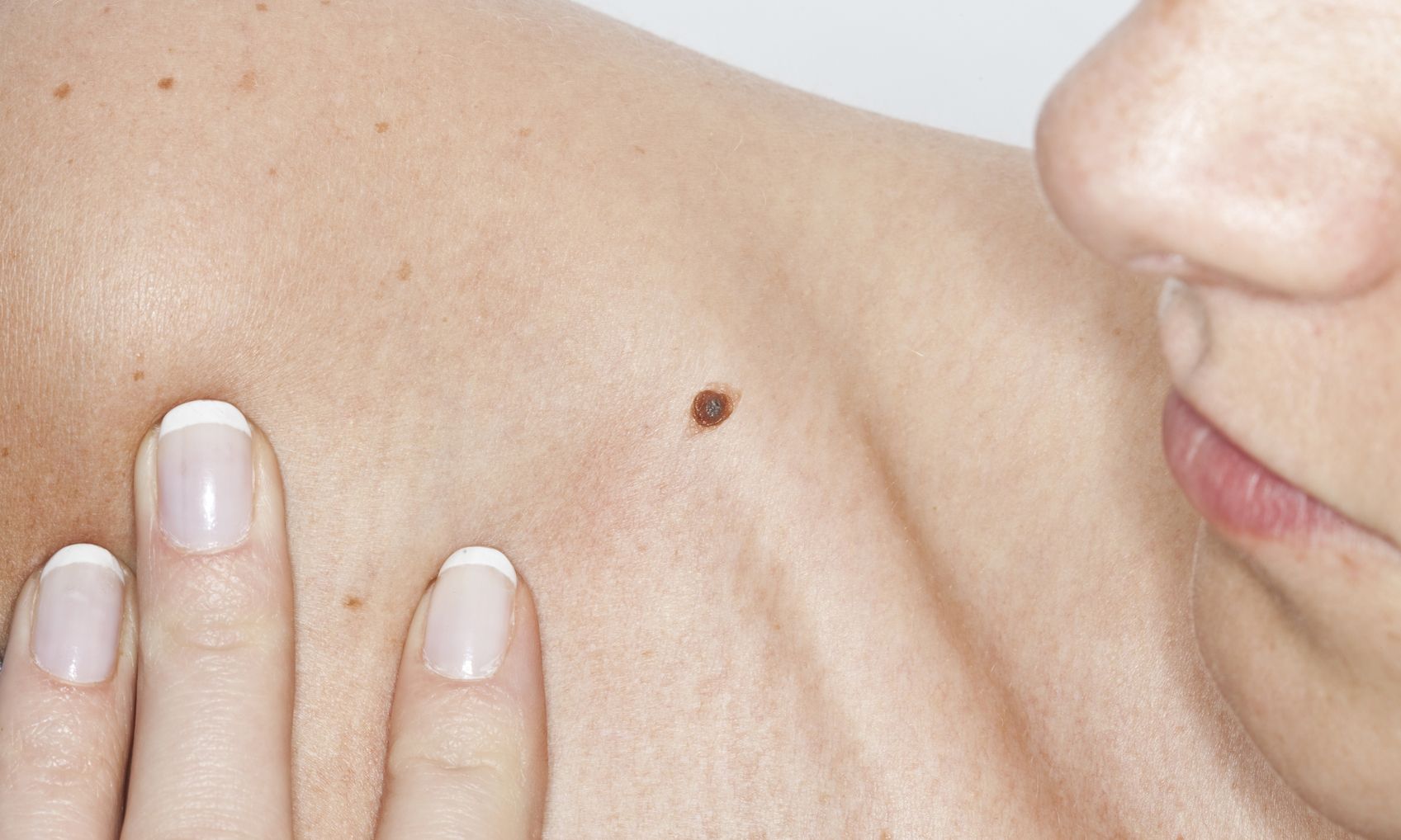 Pin op Gezondheid - Hoe Ziet Een Melanoom Er Uit