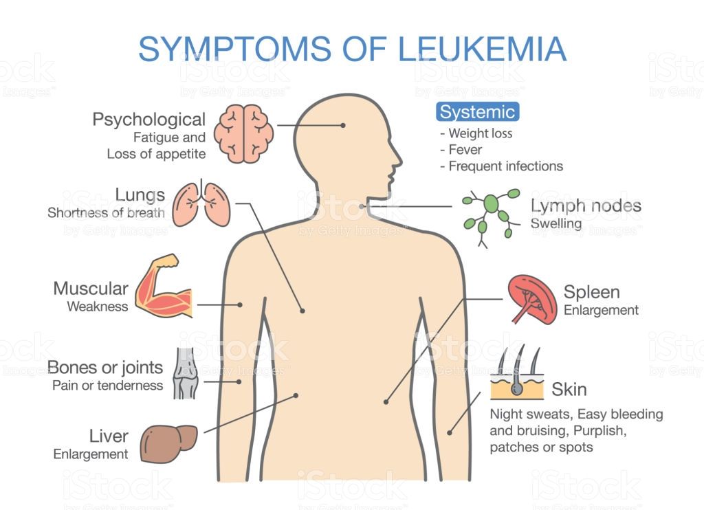 Symptomen Leukemie Kind 10 Jaar