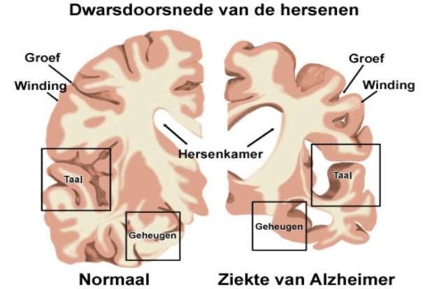 Pinterest - Wat Is De Oorzaak Van Alzheimer