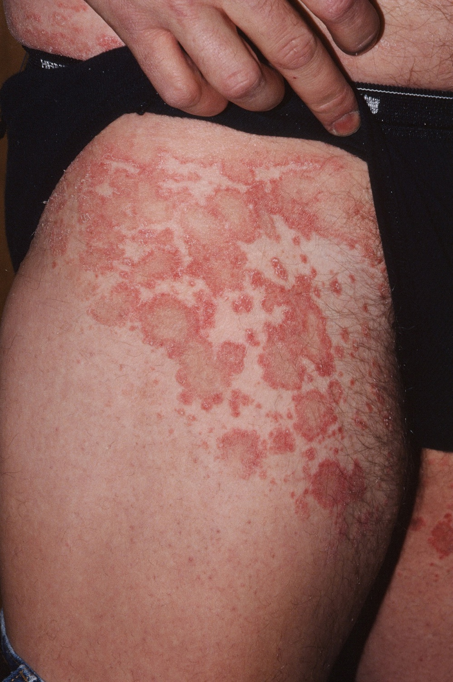 Pityriasis Versicolor Bruine Vlekken Op Huid Schimmel