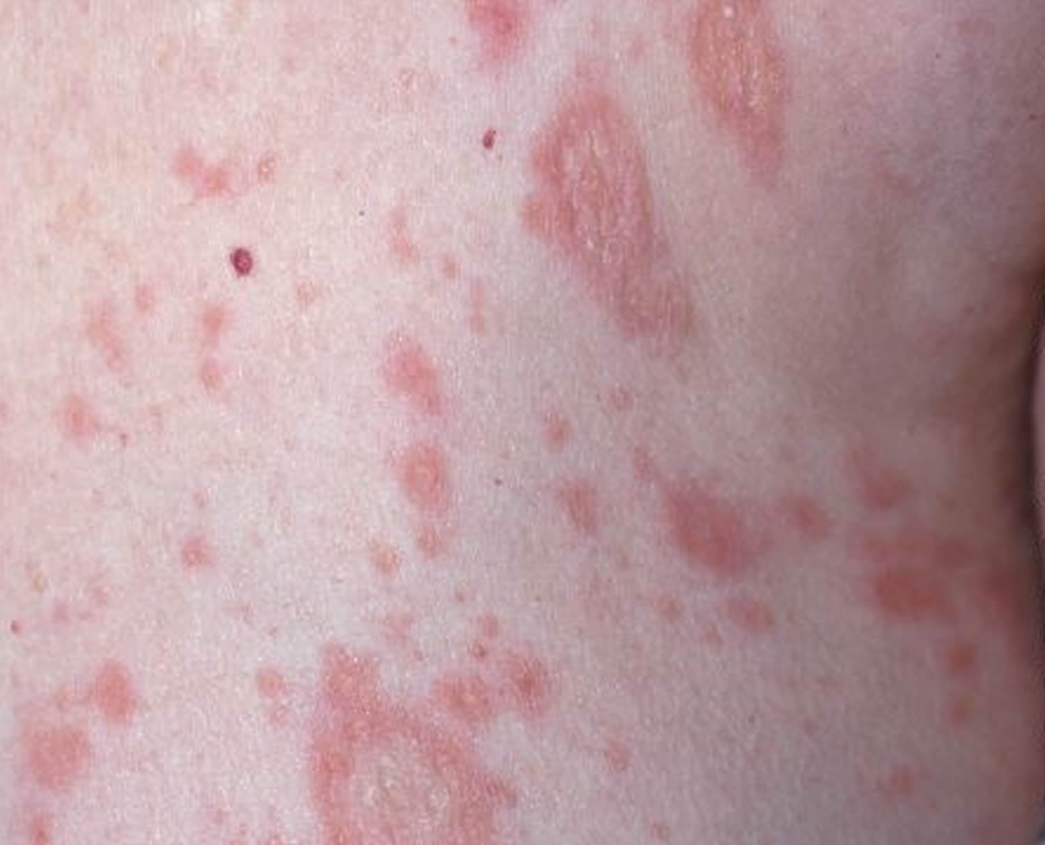 Pityriasis Rosea - Causes, Rash, Herald Patch, Stages, Treatment - Pityriasis Versicolor Bruine Vlekken Op Huid Schimmel