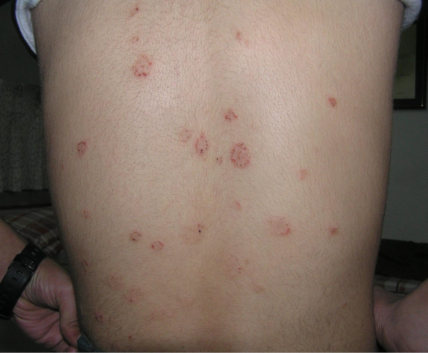 Pityriasis Rosea - Causes, Rash, Herald Patch, Stages, Treatment - Pityriasis Versicolor Bruine Vlekken Op Huid Schimmel