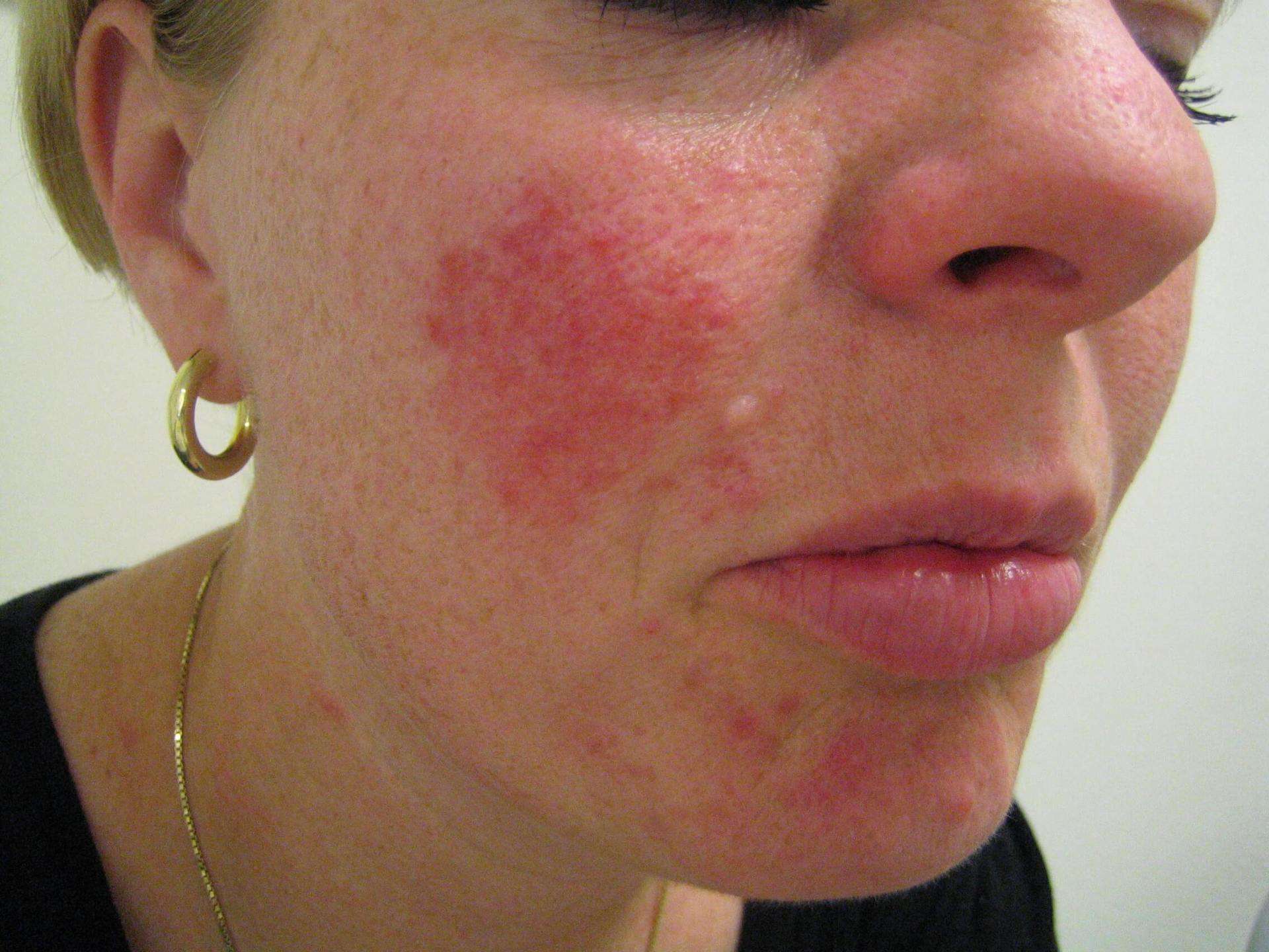 Pityrosporum Folliculitis Histology - Hoge Koorts En Rode Vlekken