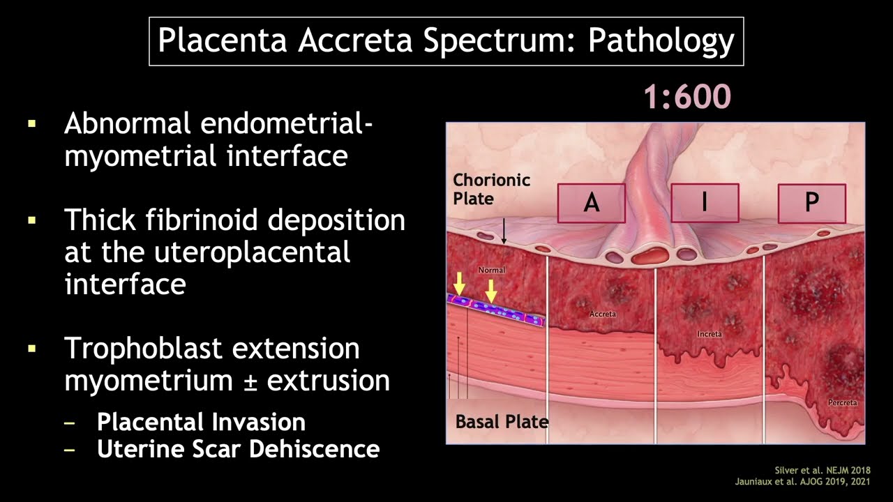Placenta Accreta Spectrum: Sonographic Markers in Early Gestation by - Hoe Ziet Een Placenta Eruit