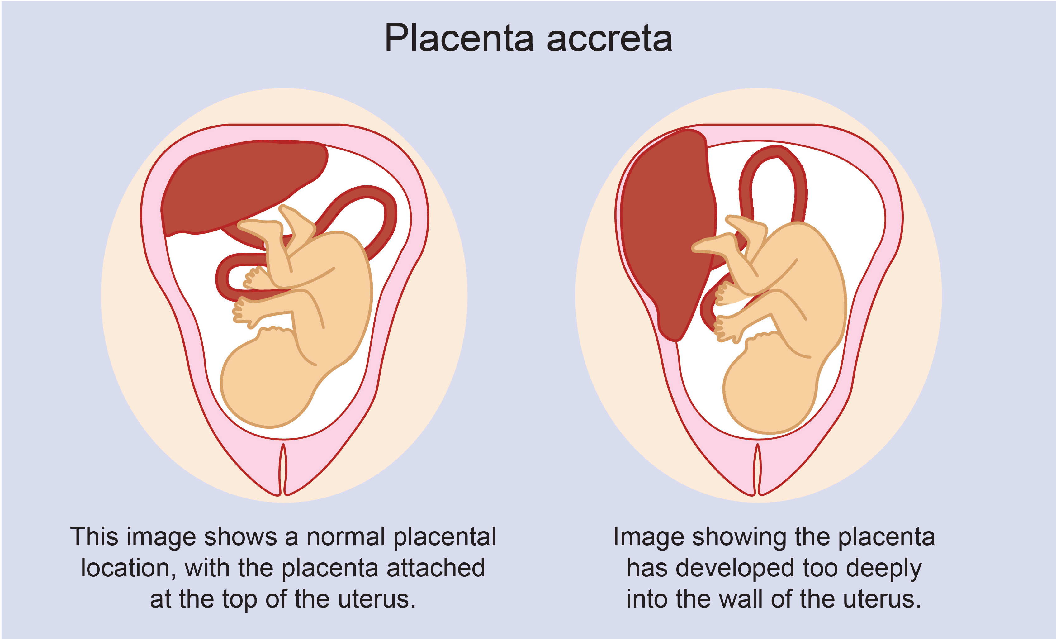 Zit De Baby In De Placenta