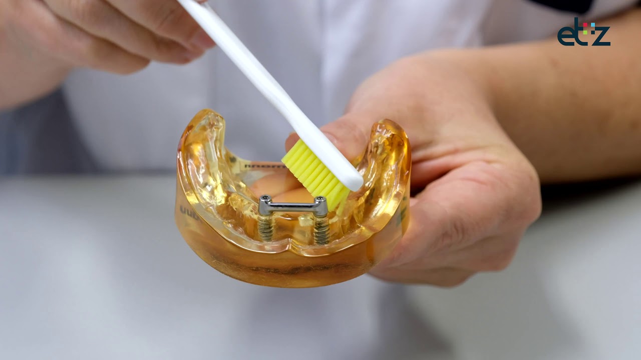 Poetsinstructie implantaten [Mond-, Kaak- en Aangezichtschirurgie - Pijn In Kaak Bij Openen Mond