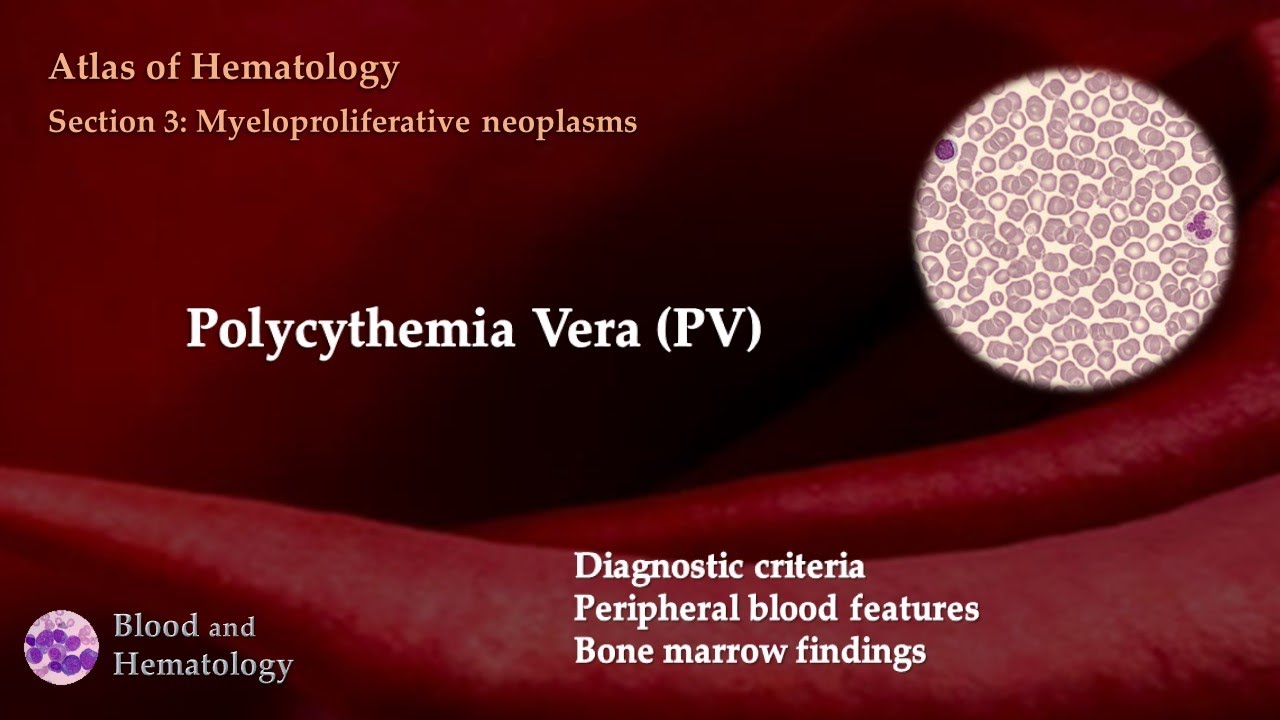 Maligne Lymfomen En Polycythaemia Vera