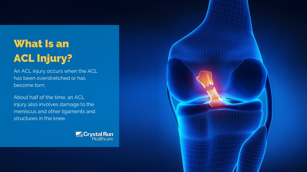 PPT - Understanding ACL Injuries PowerPoint Presentation, free download - Wat Is Een Acl Injury