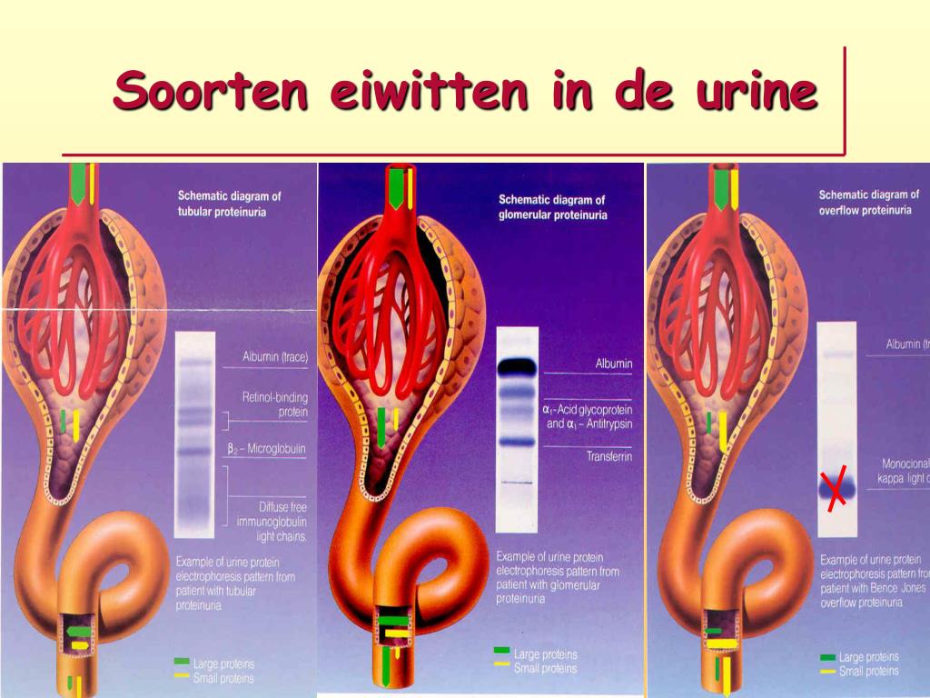 Eiwit Te Hoog In Urine