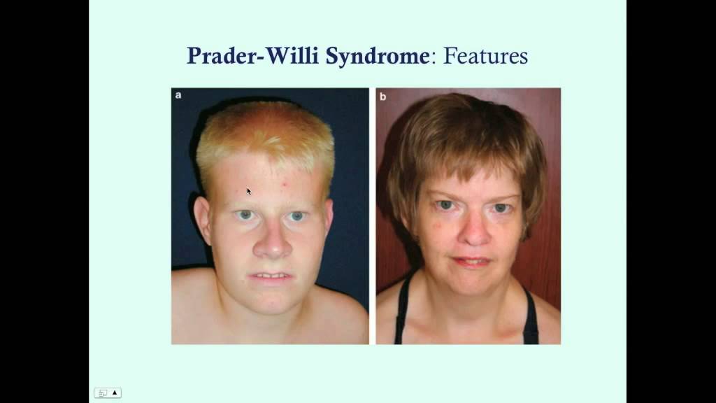 Prader-Willi Syndrome - CRASH! Medical Review Series - YouTube - Prader Willi Syndroom Uiterlijke Kenmerken