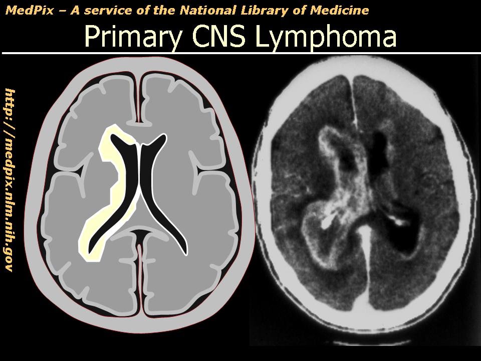 Primary CNS (Brain) Lymphoma - YouTube - Geen Maligniteit Of Cis In Deze Biopsie