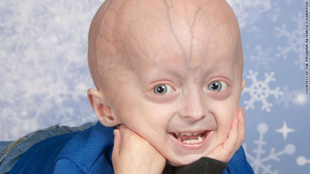 Progeria; Hutchinson-Gilford Syndrome - Hoe Oud Worden Mensen Met Progeria