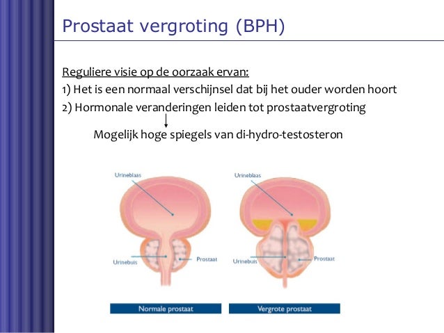 Prostaat Klachten - Waar Zit De Prostaat Van Een Man