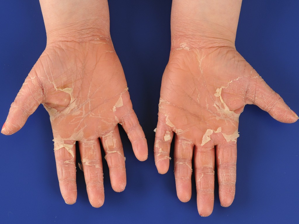 purpuric skin - pictures, photos - Abnormale Verhoorning Van De Huid