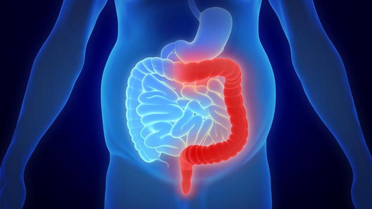 ¿Qué es la colitis ulcerosa? | Síntomas, causas y cómo tratar la enfermedad - Colitis Ulcerosa En Crohn Verschil