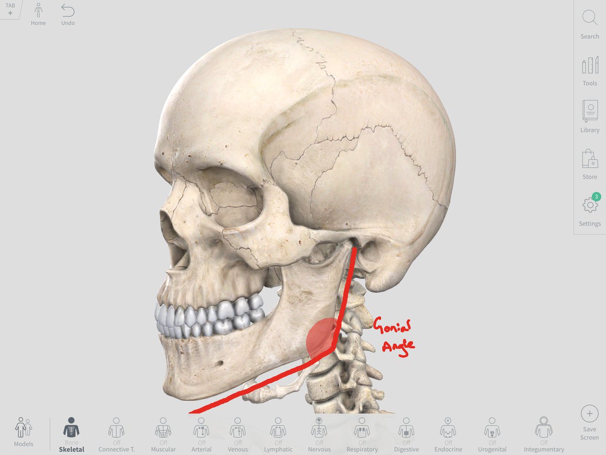 Ramus Educational - Ramus Superior En Inferior Fractuur